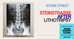 Steinstrasse-After-Lithotripsy